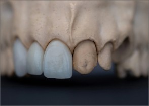 PORSELEN VE ZİRKONYUM KAPLAMALAR