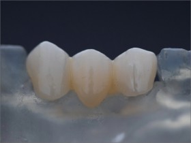 RESTORATİF DİŞ TEDAVİSİ